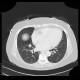 Lung carcinoma, accidental finding on enterography: CT - Computed tomography